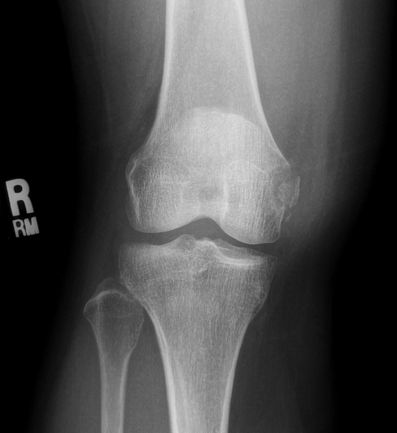 Gãy Stieda/ Gãy bong điểm bám dây chằng MCL vào lồi cầu trong xương đùi