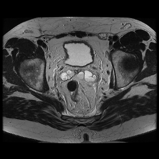 Áp xe quanh hậu môn (Perianal abscess)