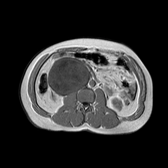 Khối u vỏ bao thần kinh ngoại biên ác tính (Malignant Peripheral Nerve Sheath Tumor - MPNST)