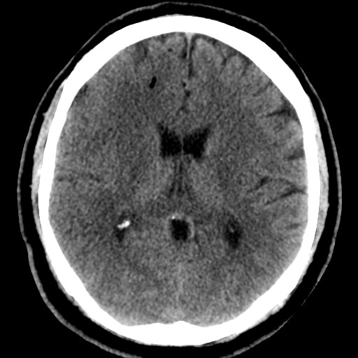 Thuyên tắc khí não (Cerebral Air Embolism - CAE)