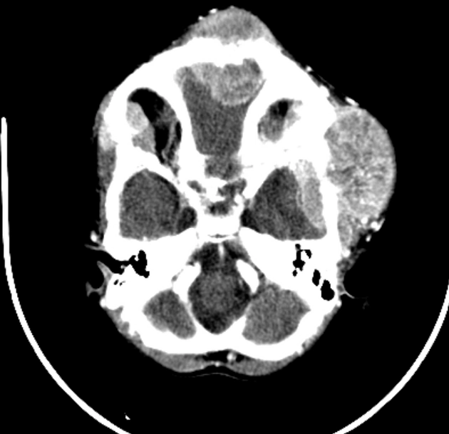 U nguyên bào thần kinh di căn (Metastatic Neuroblastoma)