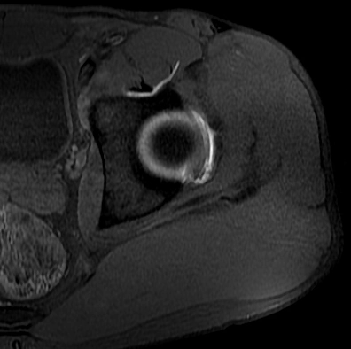 Rách sụn viền ổ cối (Acetabular labral tear)
