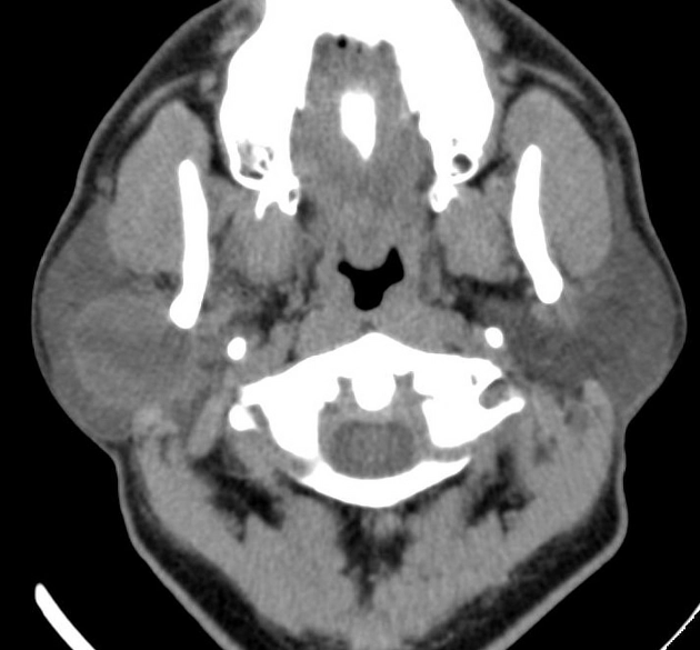 Ung thư biểu mô tế bào nang tuyến nước bọt (Acinic cell carcinoma of salivary glands)