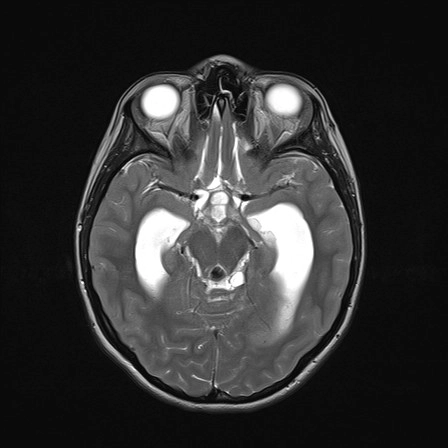 U thần kinh đệm màng mềm lan tỏa (Diffuse leptomeningeal glioneuronal tumor - DLGNT)