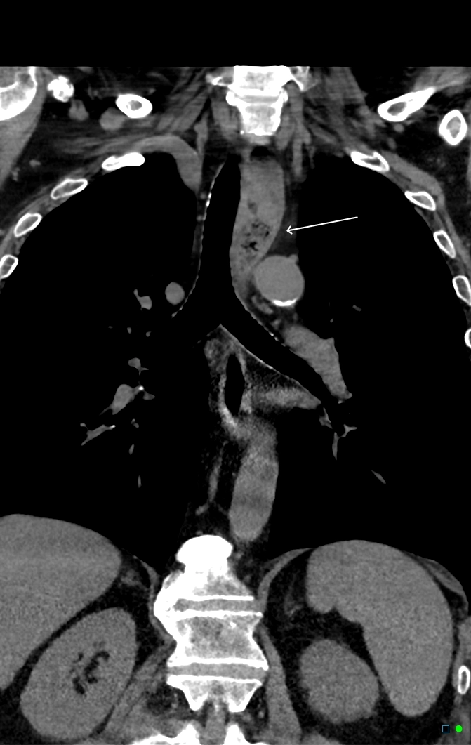 Tắc nghẽn thực quản do thức ăn (Esophageal food impaction)