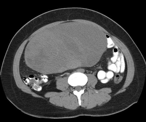 Ung thư biểu mô dạng nội mạc tử cung của buồng trứng (Endometrioid carcinoma of the ovary)
