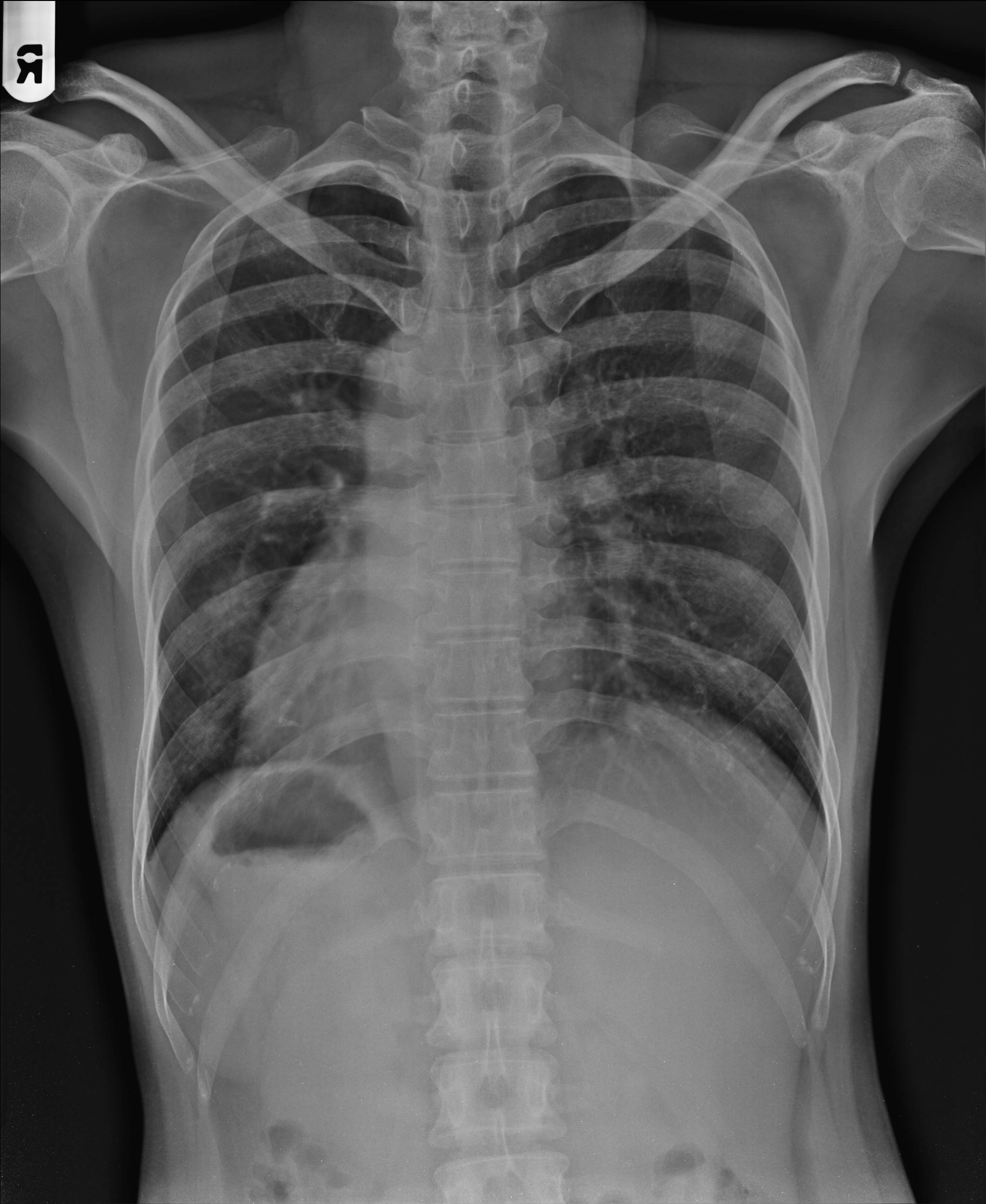 Đảo ngược phủ tạng (Situs Inversus)