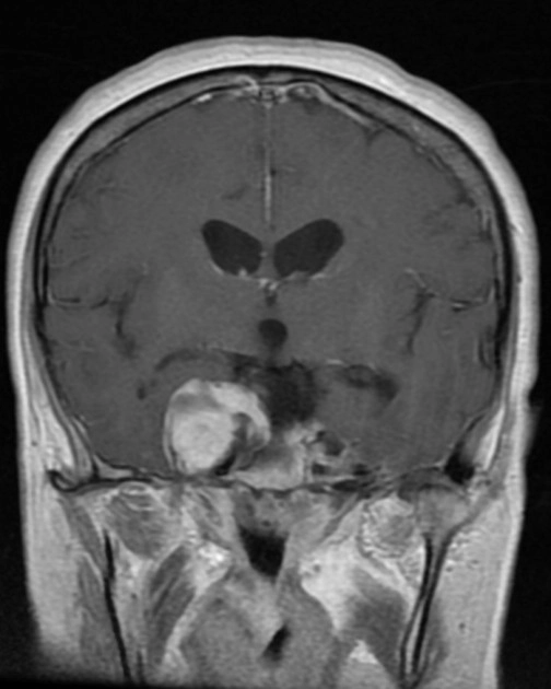 U vỏ bao thần kinh sinh ba (Trigeminal schwannomas)