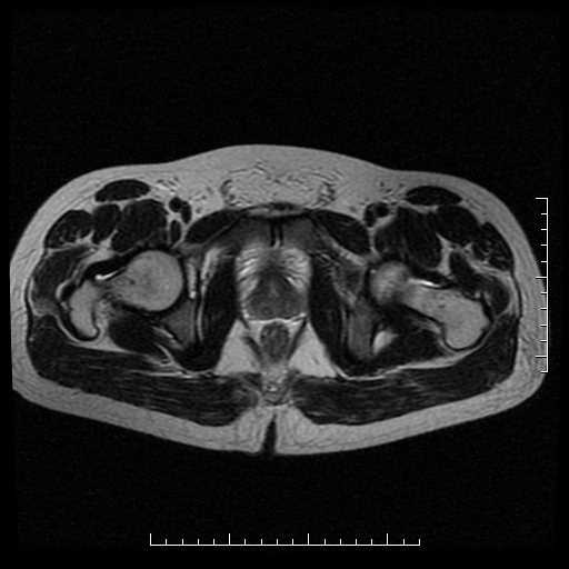 Bất sản túi tinh (Seminal vesicle agenesis)