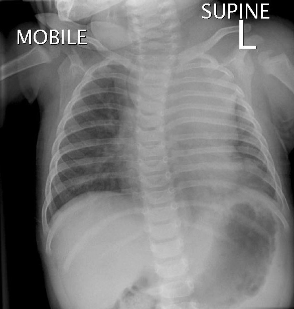 Khối choán chỗ trung thất trước trên (Anterosuperior Mediastinal Mass)