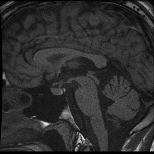 Bệnh khổng lồ (Gigantism)